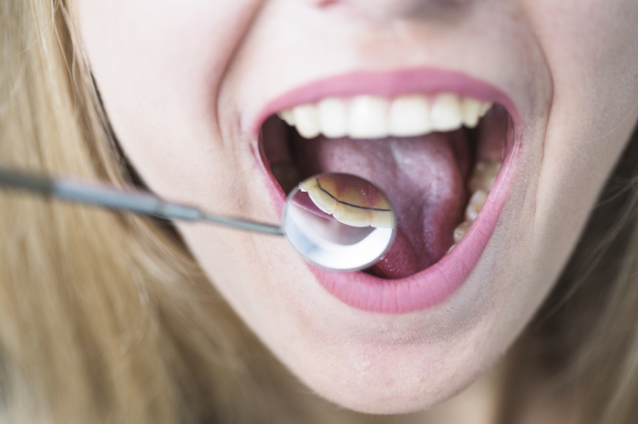 Zirkonyum Diş Nasıl Yapılır?