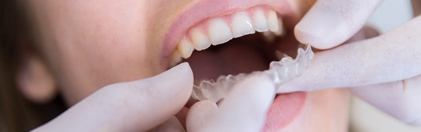Ön Diş Estetiği Nasıl Yapılır?