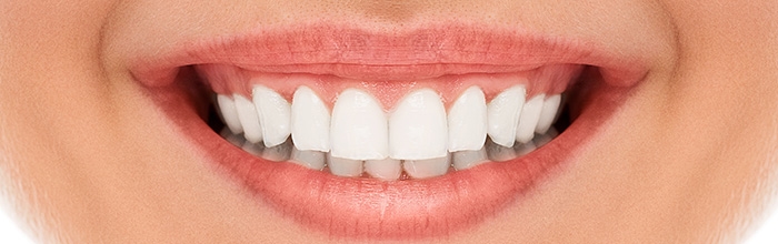 Diş Beyazlatma İşlemi Lazerle Nasıl Yapılır?